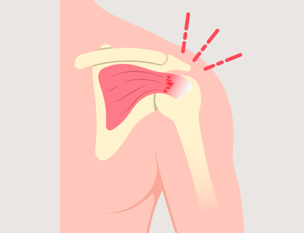 Rupture complète du tendon supra-épineux de la coiffe des rotateurs visible à l'IRM - pathologie de l'épaule traitée par kinésithérapie